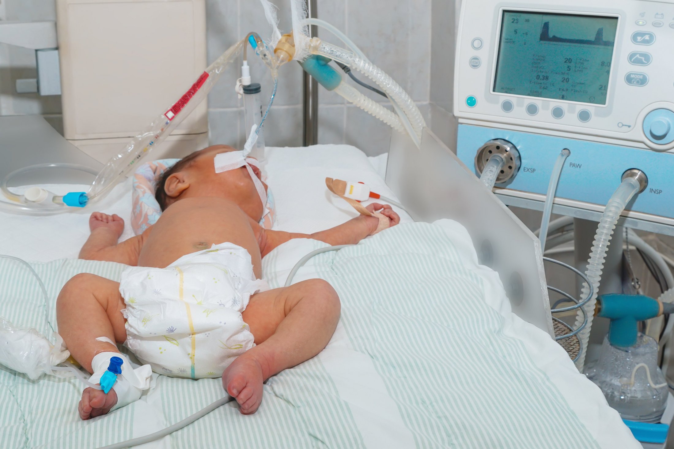 Premature baby receiving ventilator support in NICU.