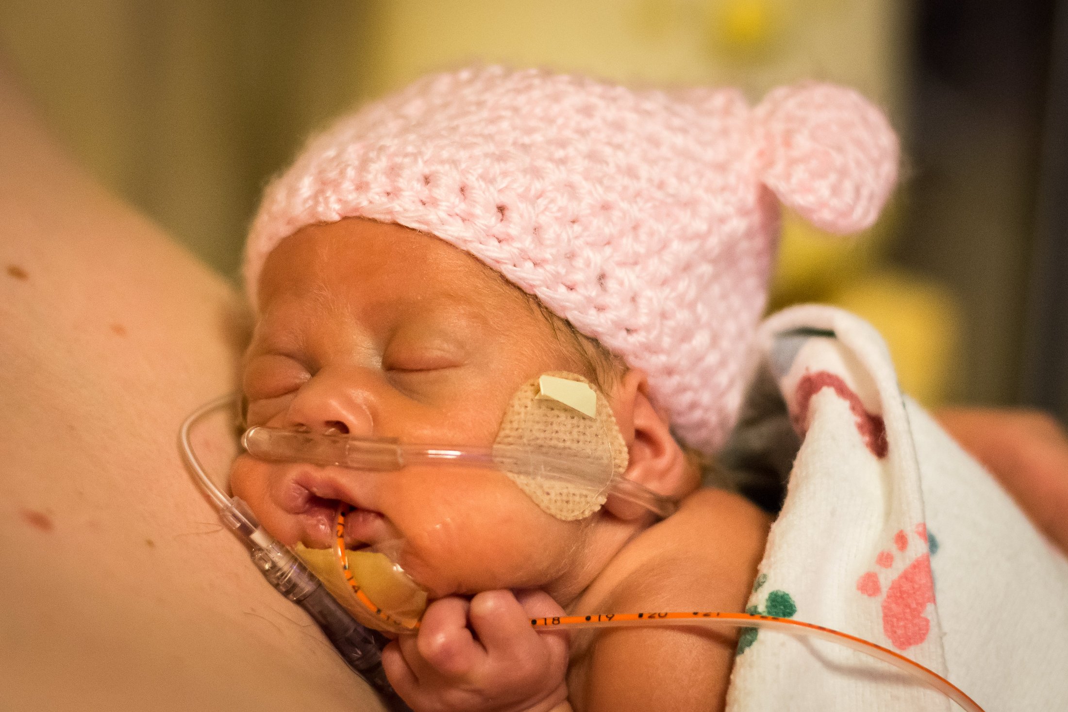 A premature baby wearing a pink hat and supported by oxygen.