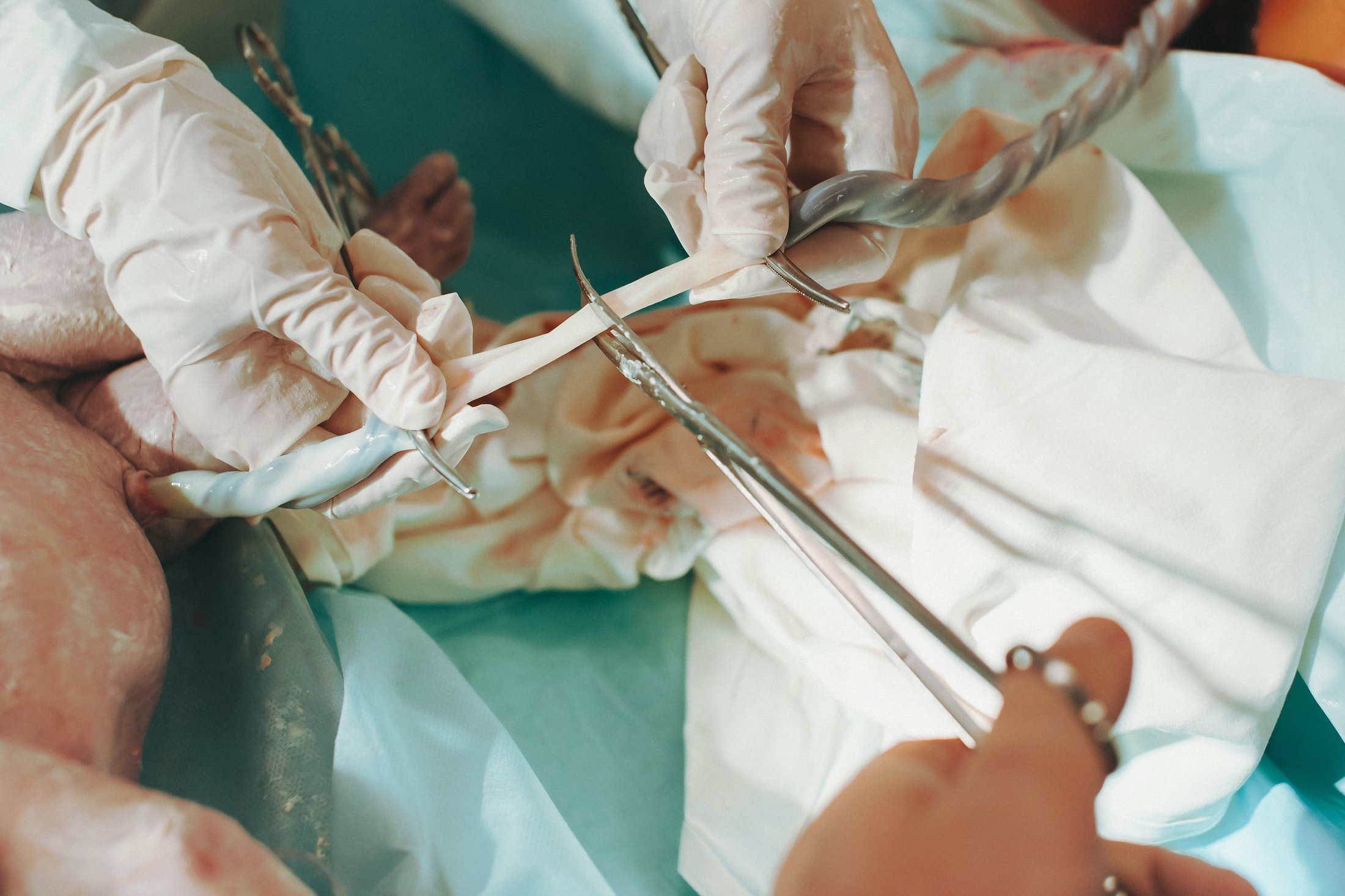 Doctor cutting the umbilical cord after a baby’s birth.
