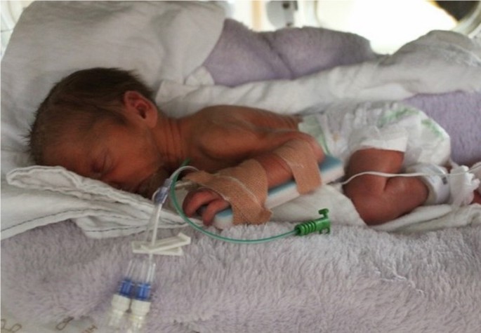 Elka, a tiny preterm baby, sleeping in an incubator with monitoring tubes, showing early life in intensive care.